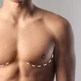 Jinekomasti Nedir? Nasıl Yapılır?