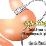 Mide kelepçesi ve gastrik bypass için başarı ve komplikasyonlarla ilgili bilgiler