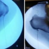 CLINICAL AND FUNCTIONAL OUTCOMES OF RADIOFREQUENCY ABLATION THERAPY IN PATIENTS WITH PLANTAR FASCIITIS