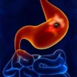 Peptik ülser nedir ?