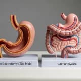 Tüp Mide mi Gastrik Bypass mı?