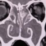 Geçmeyen Burun Tıkanıklığı: Basit Bir Grip mi, Yoksa Kronik Sinüzit mi?