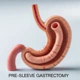 Tüp Mide Ameliyatı Riskli mi?