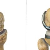 TOTAL DİZ ARTROPLASTİSİ SONRASI FİZYOTERAOPİ İŞLEVSELLİK VE DENGE