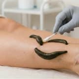 HİRUDOTERAPİ VE TIP