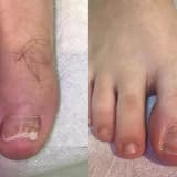 UNGUİS İNCARNATUS NEDİR ? Batık Tırnak