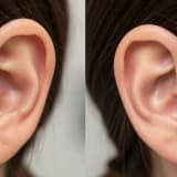 Kepçe Kulak Ameliyatı (Otoplasti) Nedir? Nasıl Yapılır ve İyileşme Süreci