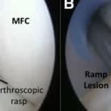 Meniscal ramp lesion repair by a trans‐septal portal technique