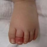 Saç Turnike Sendromu