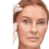 Yüz Germe (Face Lift)