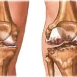 Diz Kireçlenmesi – Gonartroz(Osteoartrit)