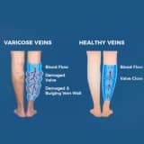 Varis Hastalarında Tedavi Yöntemleri