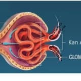 BÖBREK TAŞI NASIL OLUŞUR