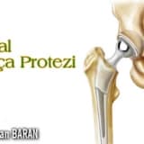 Total kalça protezi uygulaması