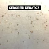 SEBOREİK KERATOZ
