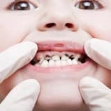Biberon Çürüğü Nedir ve Nasıl Önlenebilir ?