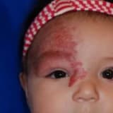 Hemanjiomun vücutta görüldüğü bölgeler