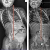 Skolyoterapide İlerleyiş ve Tedavi Yöntemleri