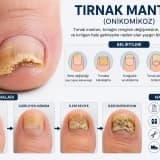 Tırnak Mantarı Nedir? Belirtileri, Nedenleri ve Etkili Tedavi Yöntemleri