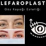 Blefaroplasti (Göz kapağı estetiği)