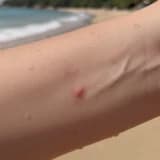 Gerçekten “Deniz Alerjisi” mi? Deniz Sonrası Kaşıntı ve Döküntülerin Nedenleri