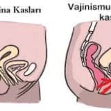 Vajinusmus Belirtileri ve Tedavisi
