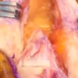 Achilles tendon-splitting approach and double-row suture anchor repair for Haglund syndrome