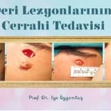 Cerrahi Tedavi Gerektiren Deri Lezyonları