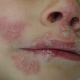 HERPES VİRÜS ENFEKSİYONLARI
