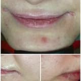 ANGÜLER KEİLİT (PERLEŞ)