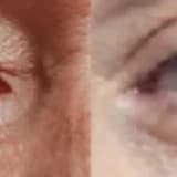 Blefaroplasti Nedir?