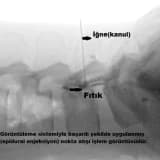 Ameliyatsız bel fıtığı tedavisi