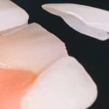 Porselen Lamina Nedir?