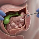 Safra Kesesi Taşı Tespit Edildi: Ameliyat Gerçekten Gerekli mi?