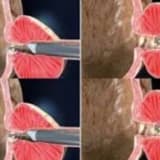 TUR Prostat: BPH Tedavisinde Kullanılan Etkili Cerrahi Yöntem