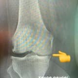 Diz Kireçlenmesi (Gonartroz) ve Tedavisi
