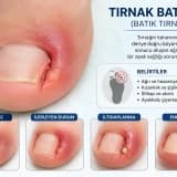 Tırnak Batması Nedir? Tedavi yöntemleri nelerdir?