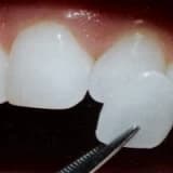 Laminate porselenler !