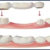 Kuron- köprü tedavileri