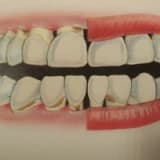 Dişeti iltihabı nasıl oluşur?