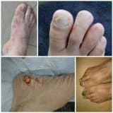 TİNEA PEDİS yani AYAK MANTARI