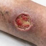 Varis Yarası (Venöz Ülser) Nedir ve Nasıl Tedavi Edilir?