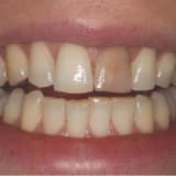 Kanal Tedavili Dişlerde Renklenme