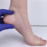 Diyabetik Ayak