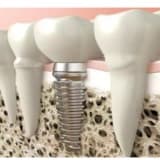 İmplant Diş Tedavisi Nedir?