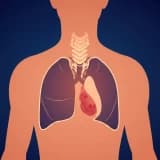 Mediastinal Tümör Tedavisinde VATS (Kapalı Göğüs Cerrahisi) Yöntemi
