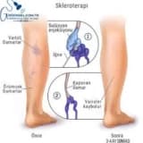 Skleroterapi tedavisi sonrası dikkat edilmesi gerekenler!!!
