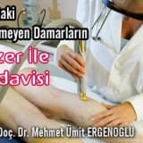 Ayaktaki istenmeyen damarların lazer ile tedavisi
