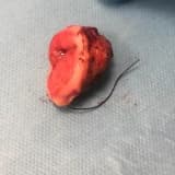 LEEP İŞLEMİ İLE RAHİM AĞZI KANSERİ OLMADAN: CİN2-3 TEDAVİSİ MÜMKÜN