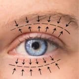 Göz Kapağı Estetiği (Blefaroplasti)